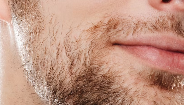 Micropigmentação de barba antes e depois em Moema